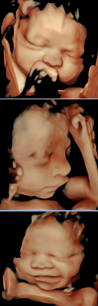 3D Ultrasound